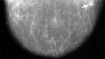 Mammogram